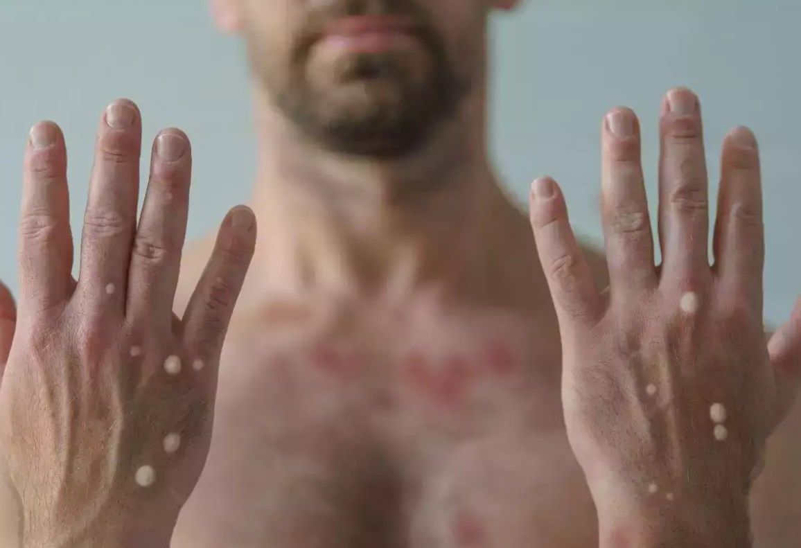 Mot benh truyen nhiem lai gia tang tai My hinh anh