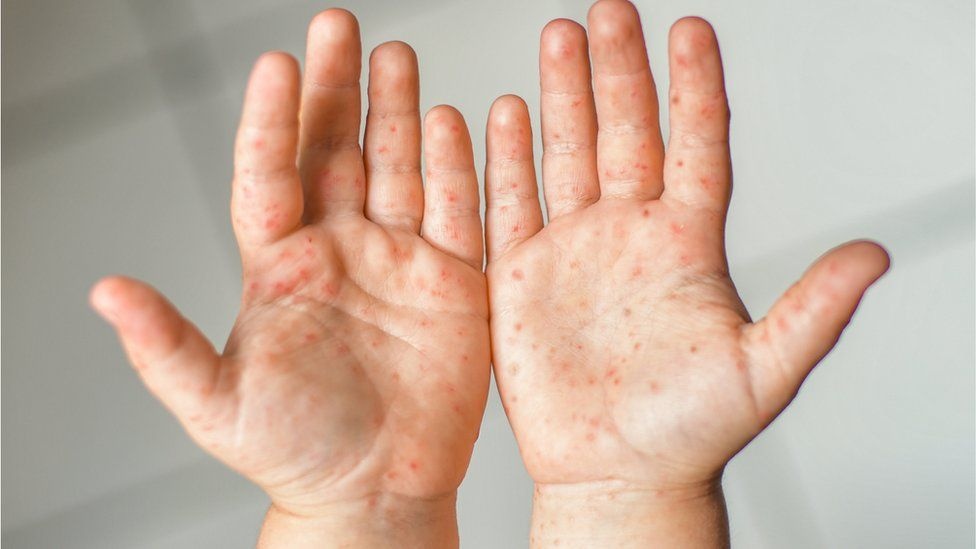 Dau hieu canh bao som tay chan mieng hinh anh