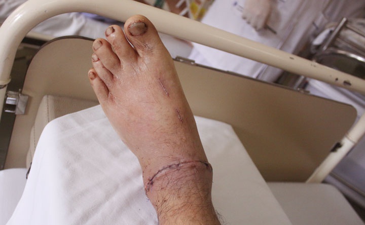 Nguoi dan ong nhap vien voi co chan sap dut lia hinh anh