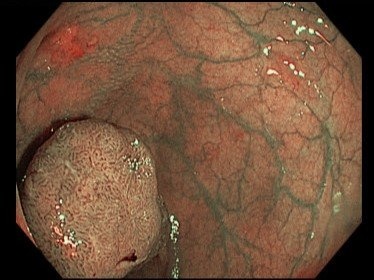 mac 2 loai ung thu anh 1