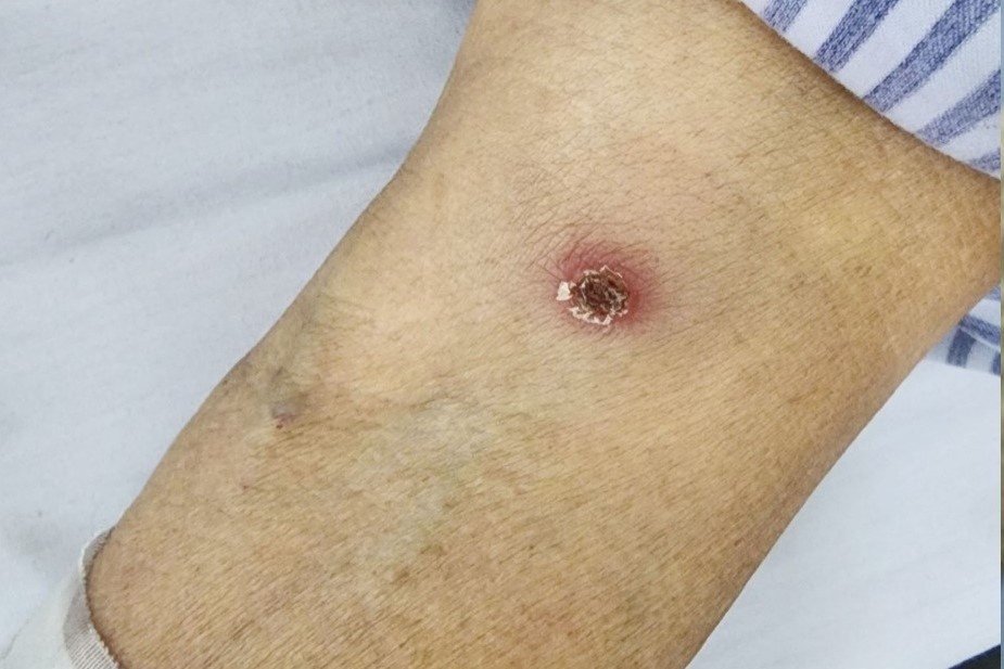 Nguoi phu nu mac benh nguy hiem vi vet loet nho hinh anh