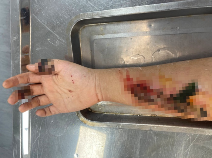 Canh tay hoai tu chi chit do dap la vao vet thuong hinh anh