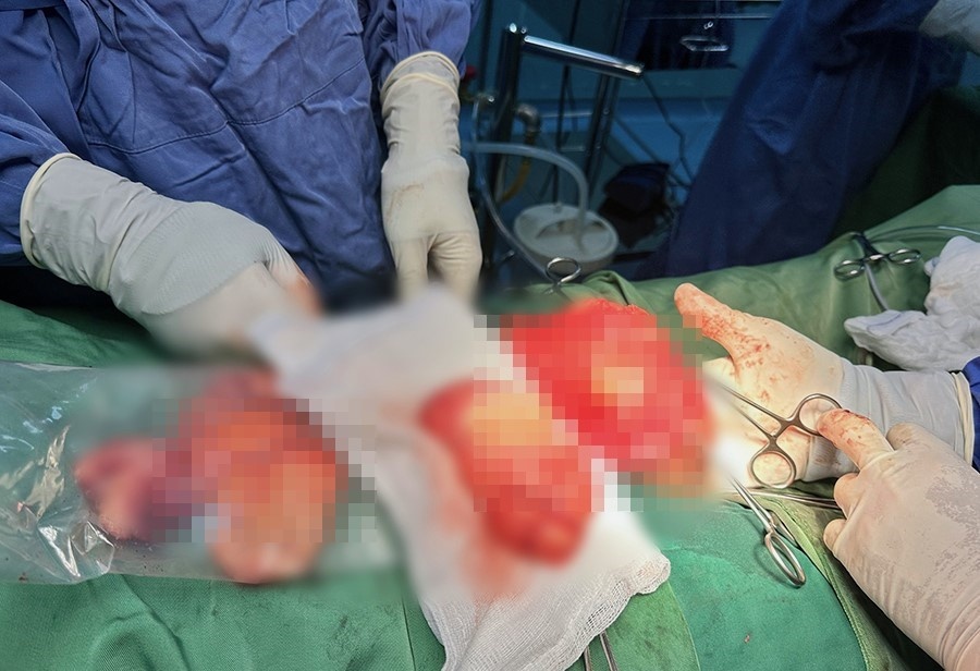 Nguoi dan ong mang khoi u tinh hoan nang gan 1 kg hinh anh