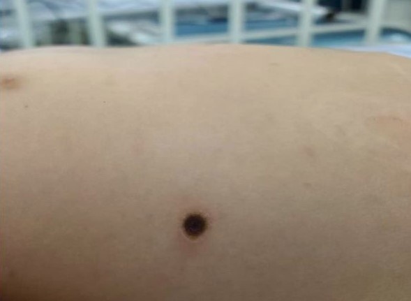 Can benh nguy hiem tu vet loet tron nho hinh anh