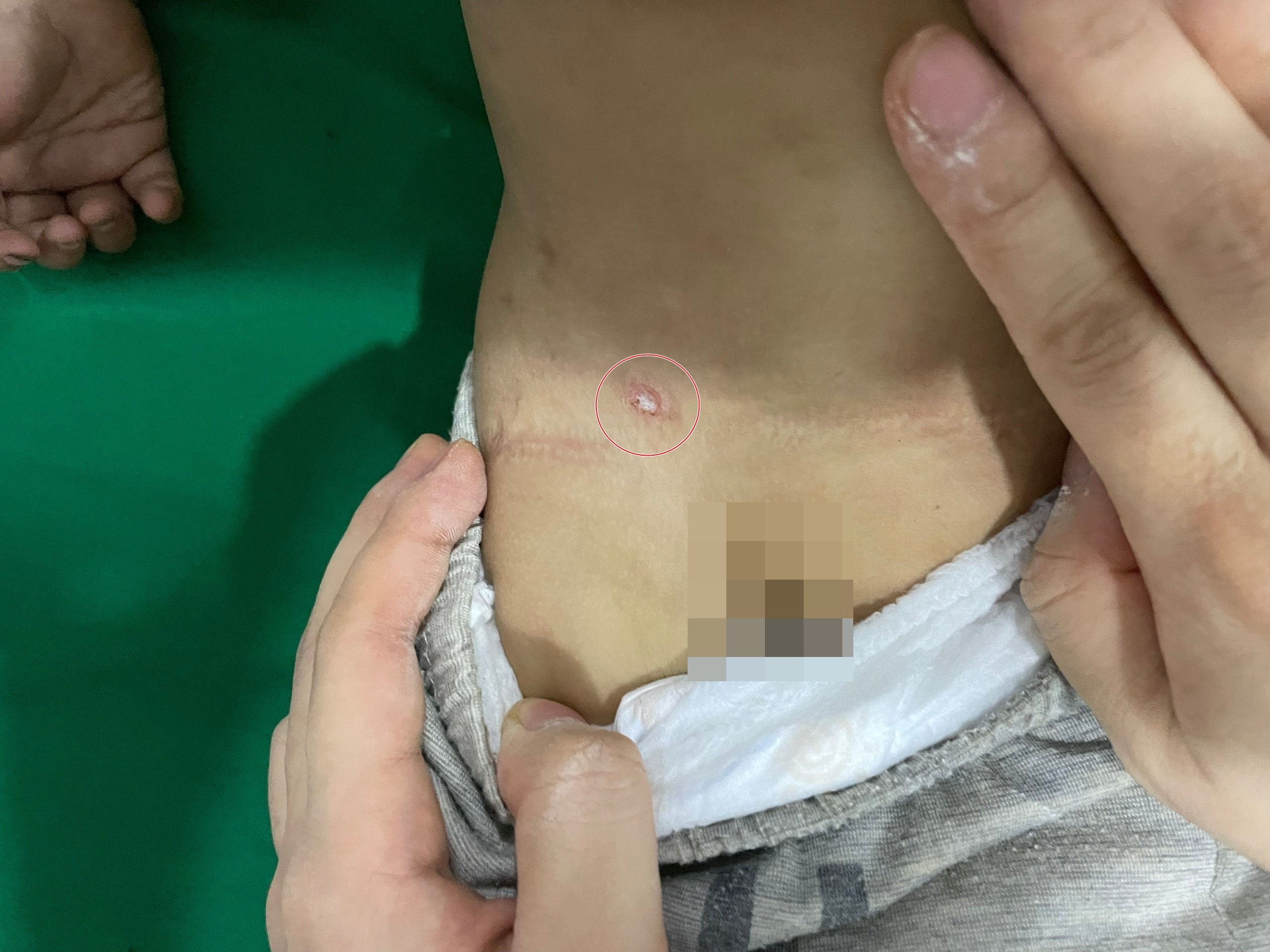 Vet dot gay nguy hiem cho be 15 thang tuoi hinh anh