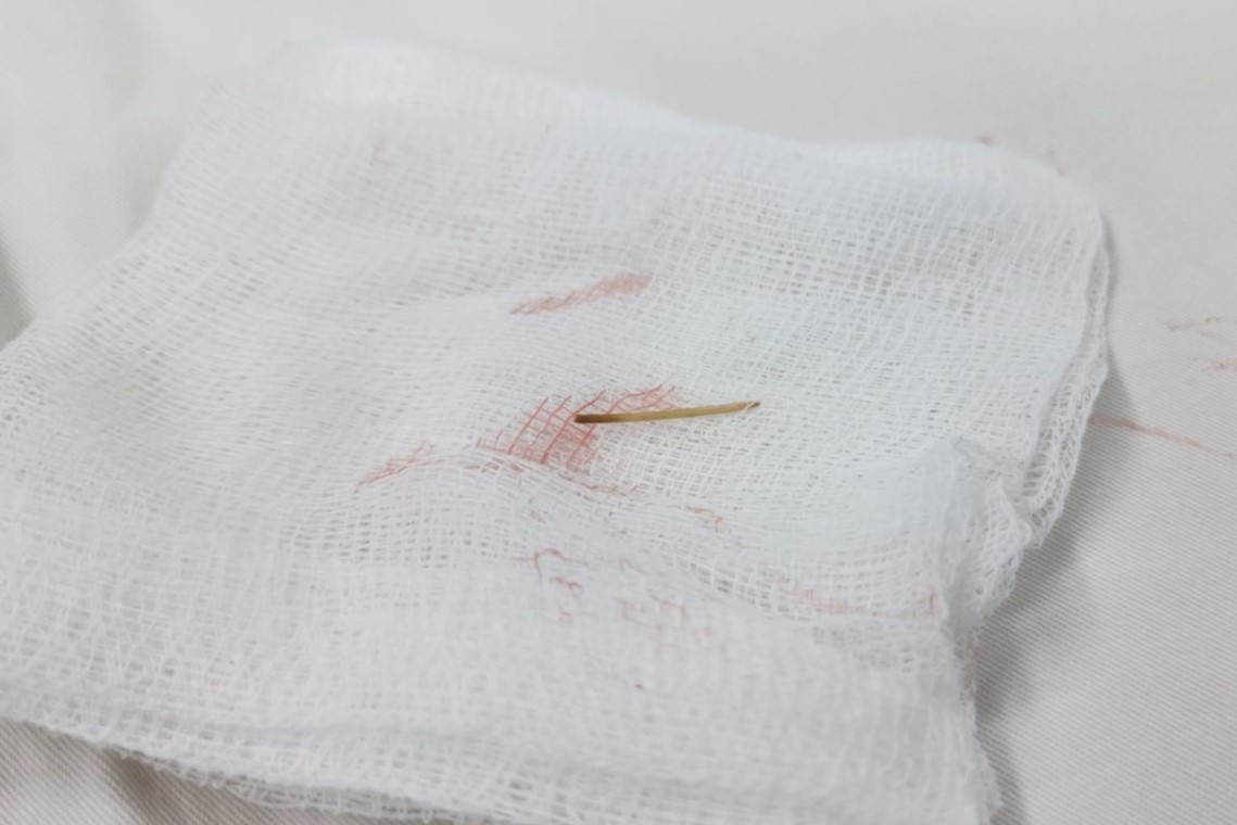 'Thu pham' khong ngo khien nguoi phu nu dau bung lien tuc hinh anh