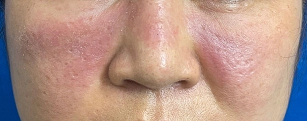 bien chung tiem filler anh 1