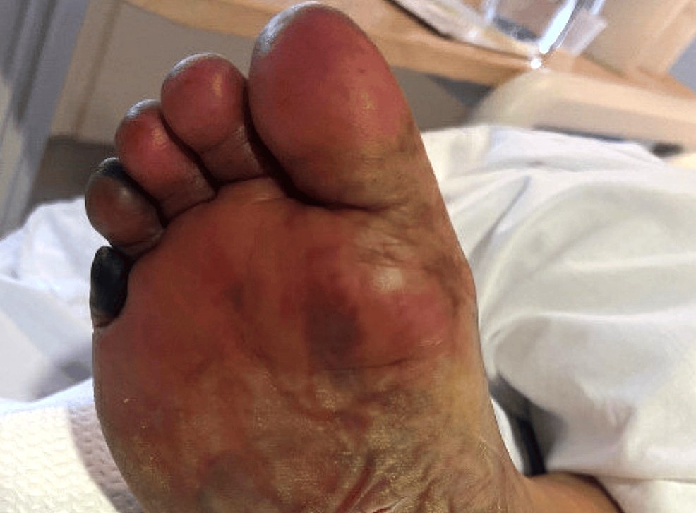 Loai vi khuan 'an thit nguoi' dang lay lan tai Nhat Ban hinh anh