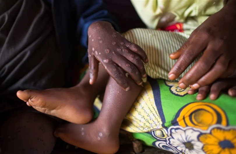 Virus dau mua khi dang gay benh nang hon hinh anh