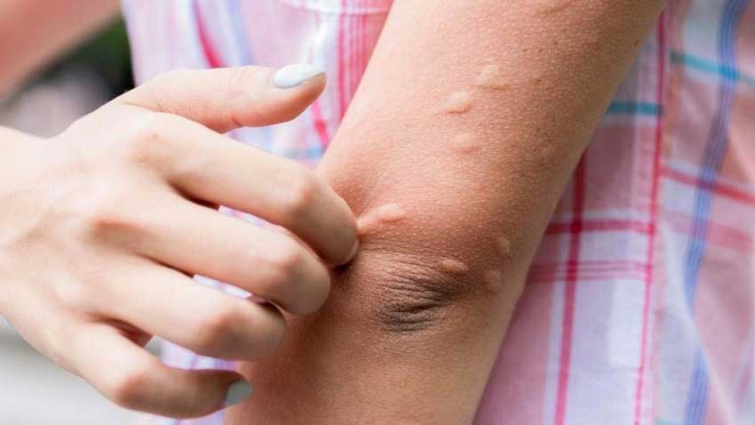 Canh giac voi benh viem nao Nhat Ban voi tre em trong mua he hinh anh