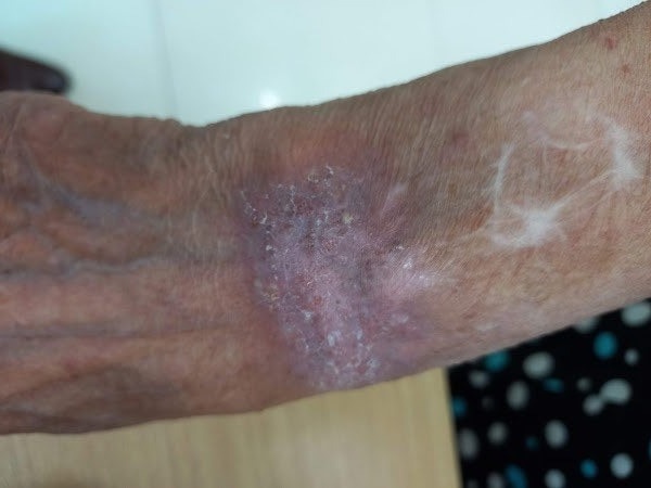 Mot nguoi o Phu Tho mac benh lao da hiem gap hinh anh