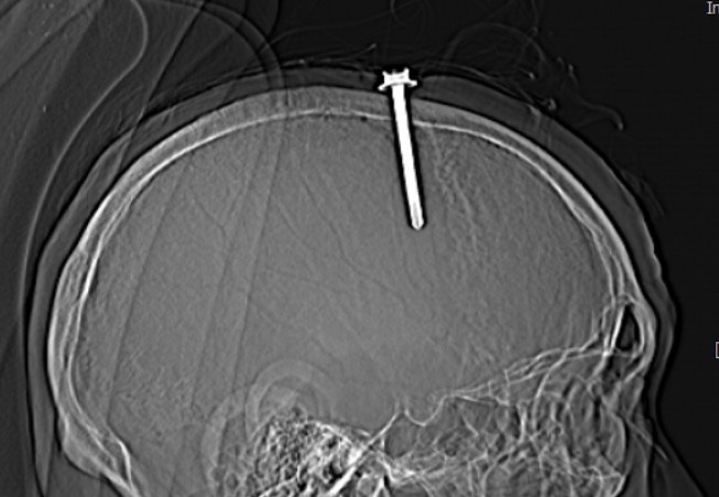 Nguoi dan ong tram cam tu dong dinh sat vao dau hinh anh