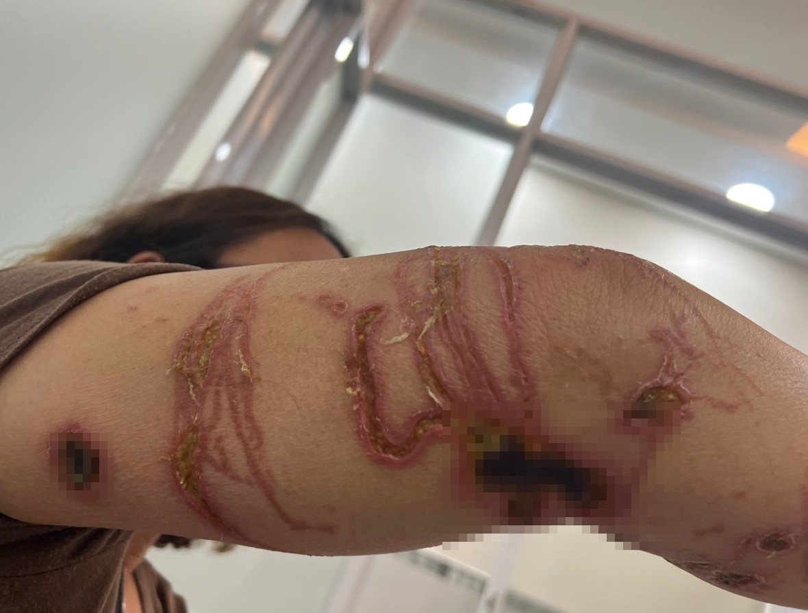 Tay chan lo loet sau khi tam bien hinh anh