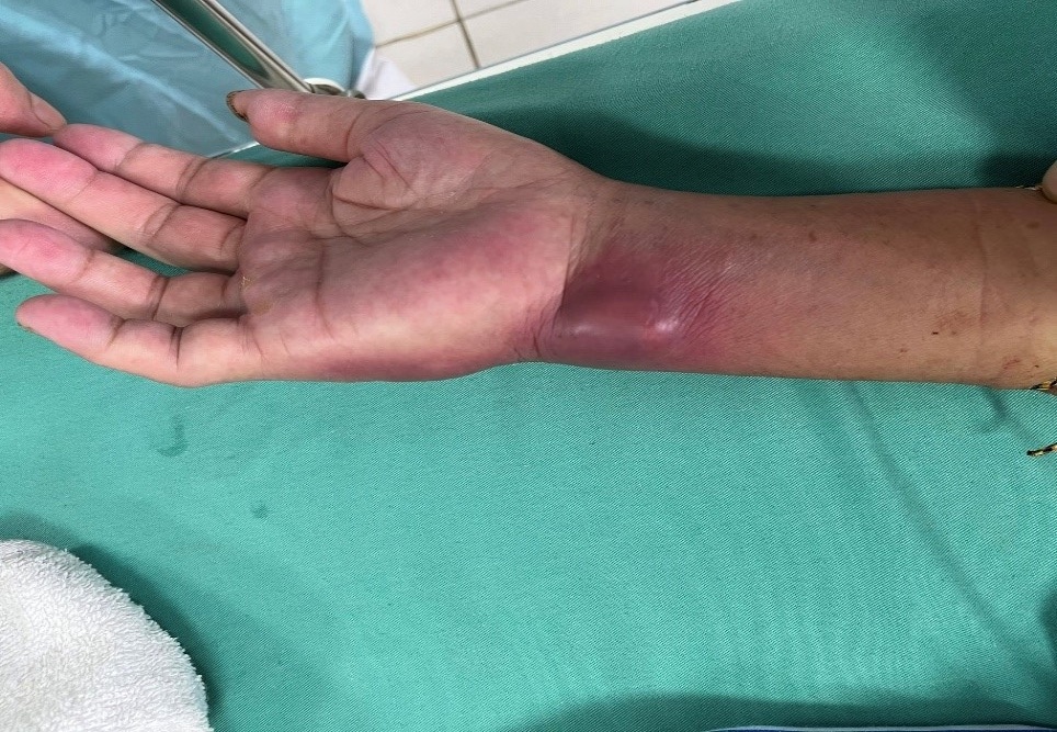 Co tay sung hup, ap xe cua benh nhan nhiem vi khuan 'an thit nguoi' hinh anh