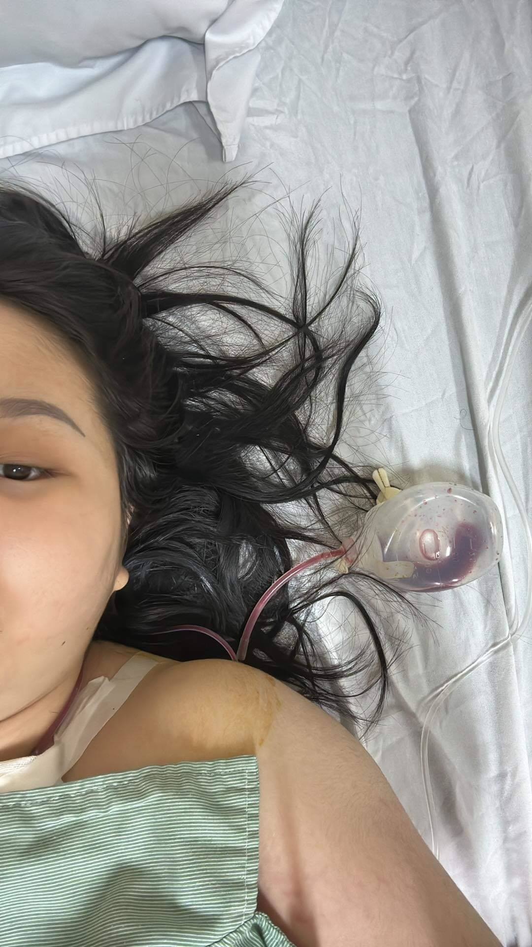 ung thu anh 6