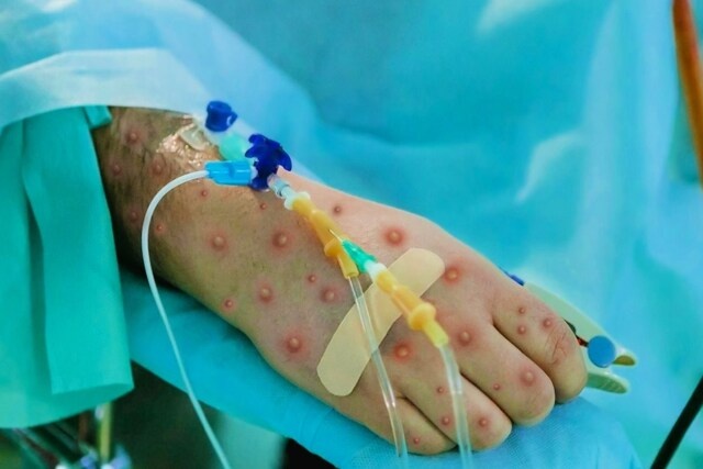 WHO can nhac ban bo tinh trang khan cap ve dau mua khi hinh anh