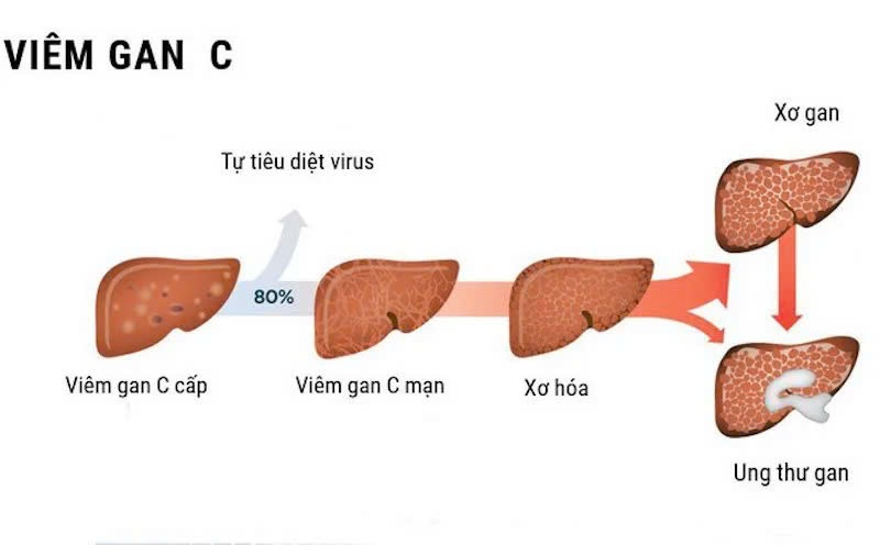 viem gan sieu vi C anh 1