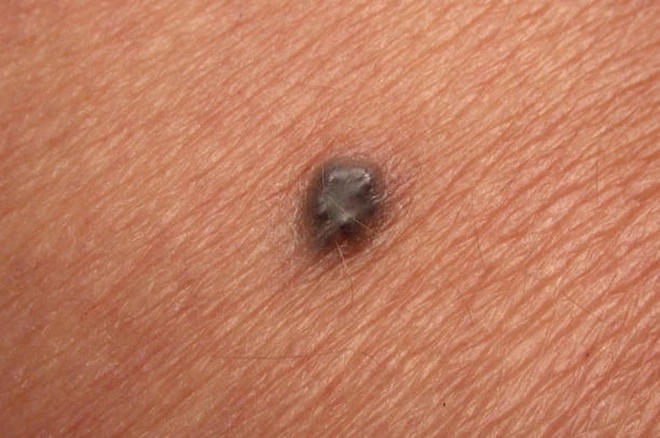 Vi sao not ruoi co the la dau hieu cua benh ung thu nguy hiem hinh anh