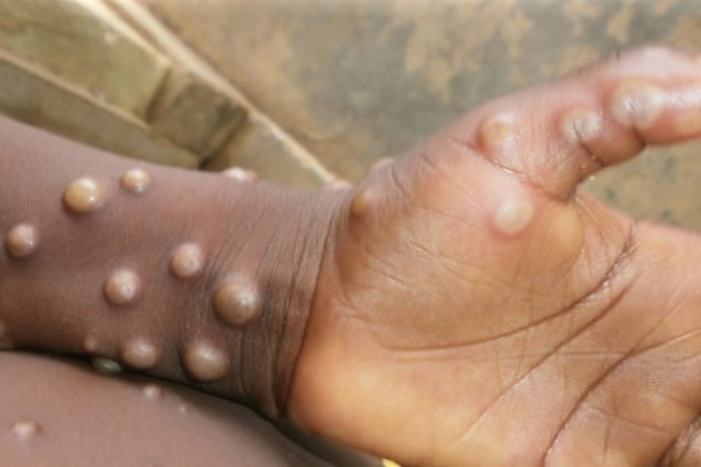 Cam giac dau don khi mac benh dau mua khi hinh anh