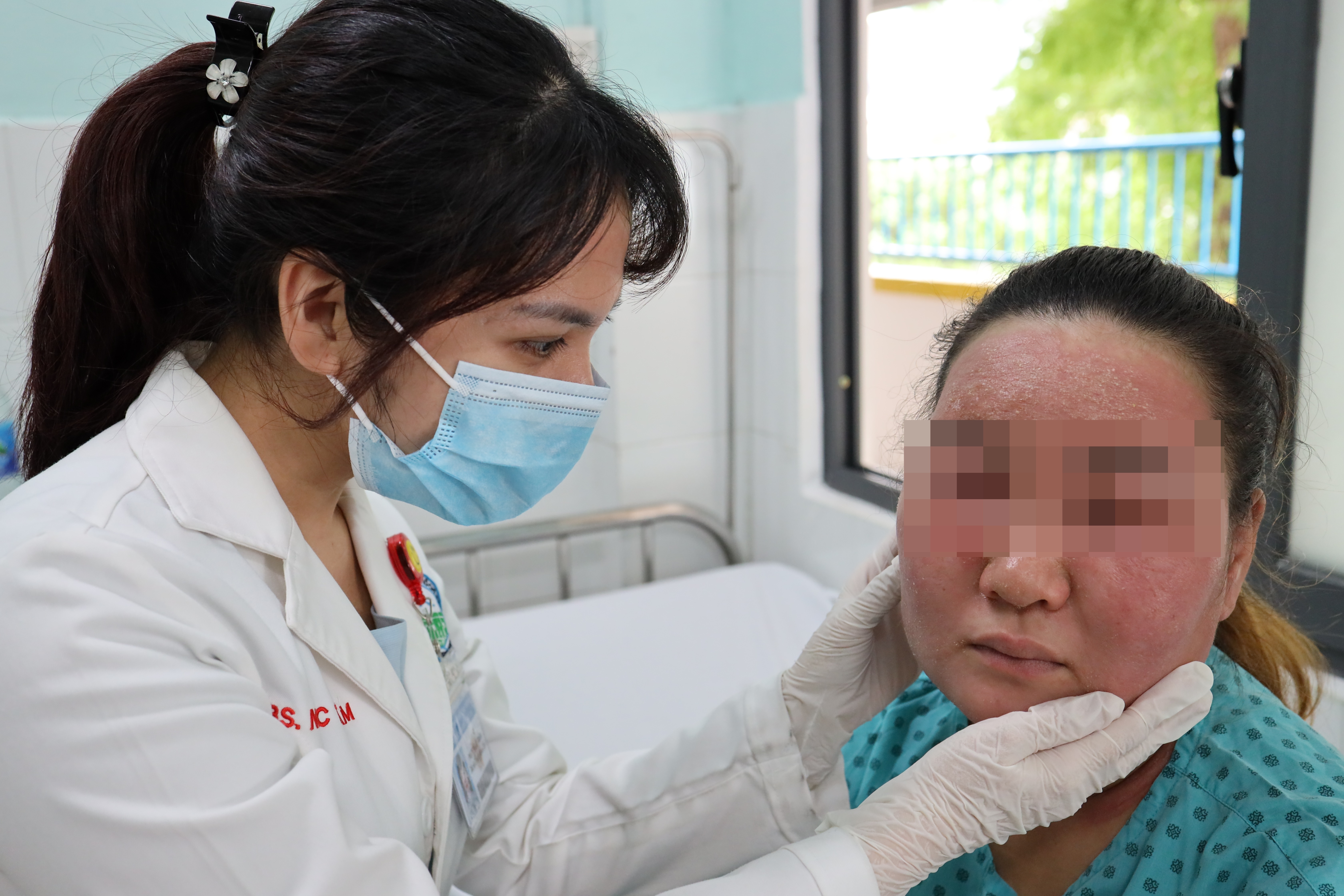 Mat mui sung hip sau khi tu dung hoa chat lot da hinh anh