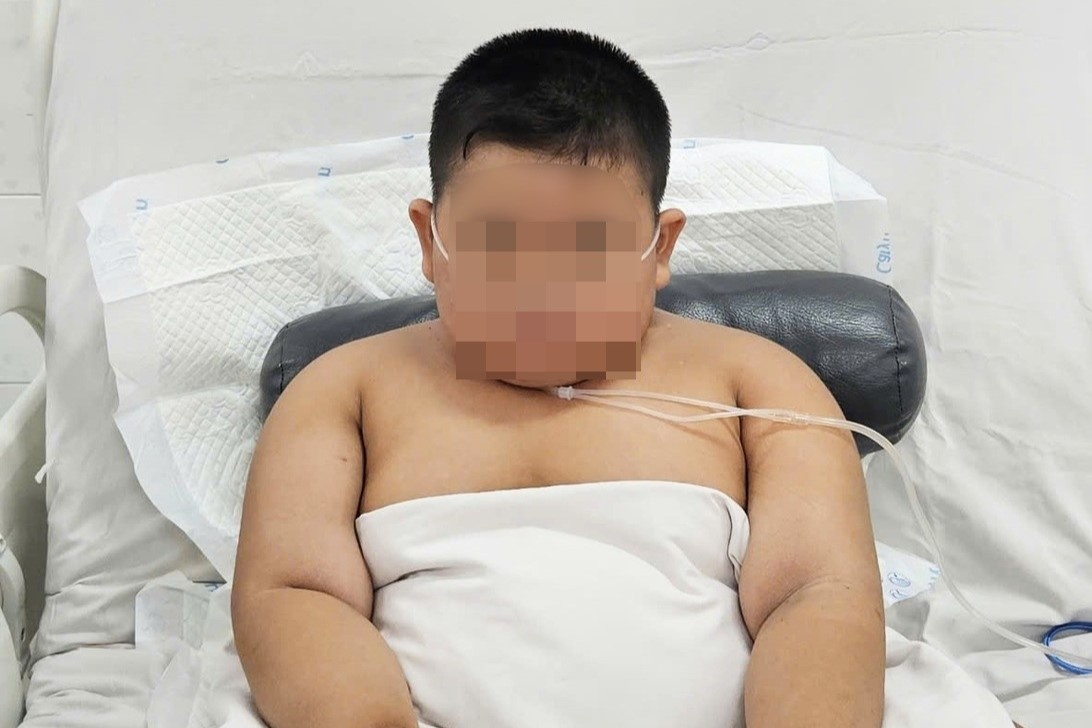 Be trai tang 35 kg trong 6 thang, nguy kich sau 3 ngay nhiem cum hinh anh