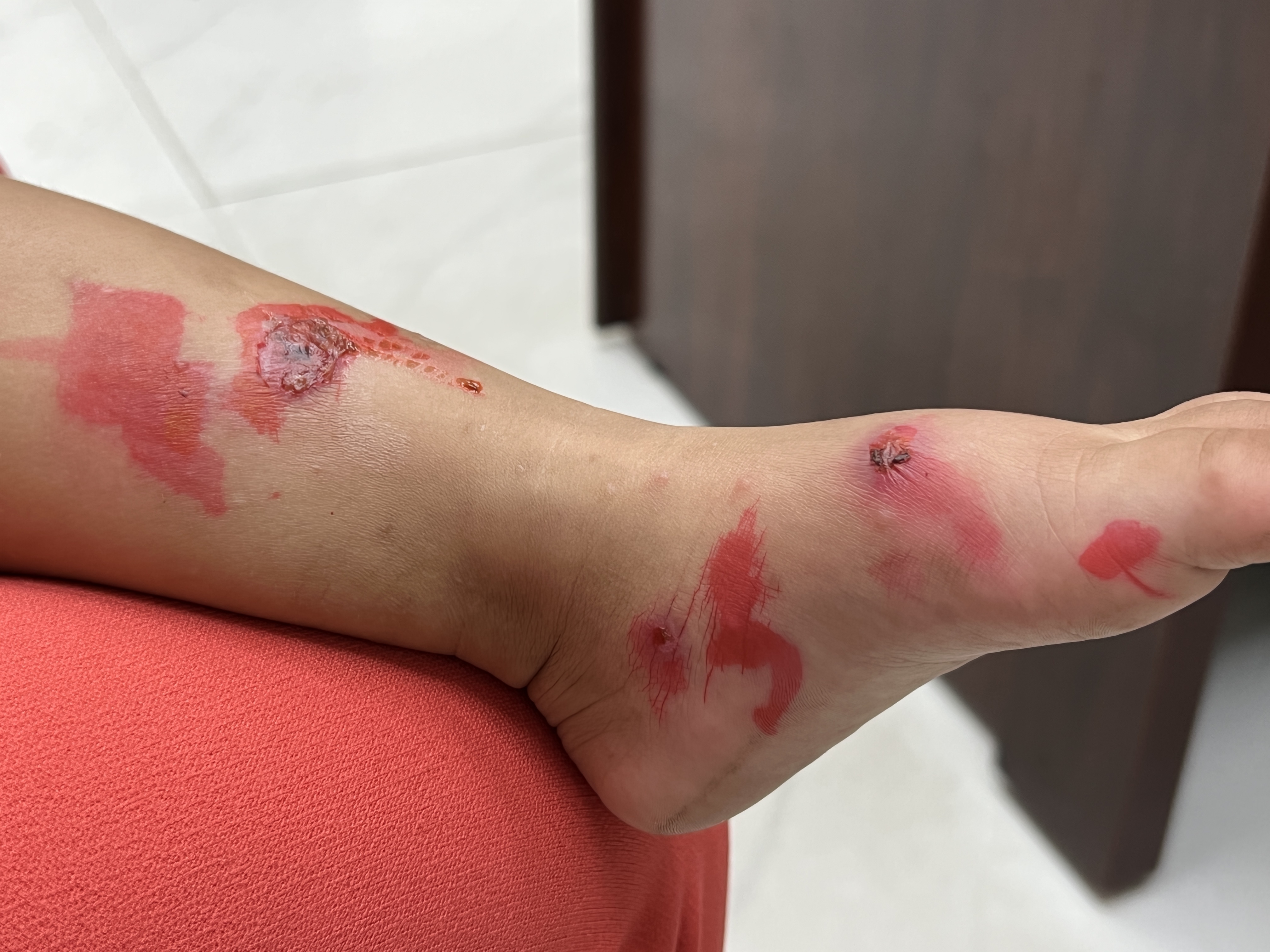 Di hoc tro lai, benh choc lay lan nhanh o tre hinh anh