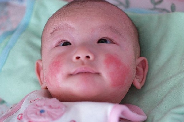 Lam sao de xoa vet bot tren mat tre? hinh anh