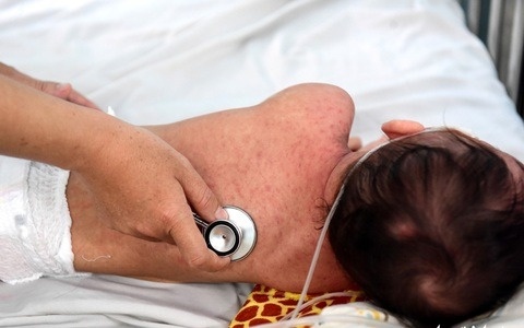 Benh soi co thuoc dieu tri dac hieu khong? hinh anh