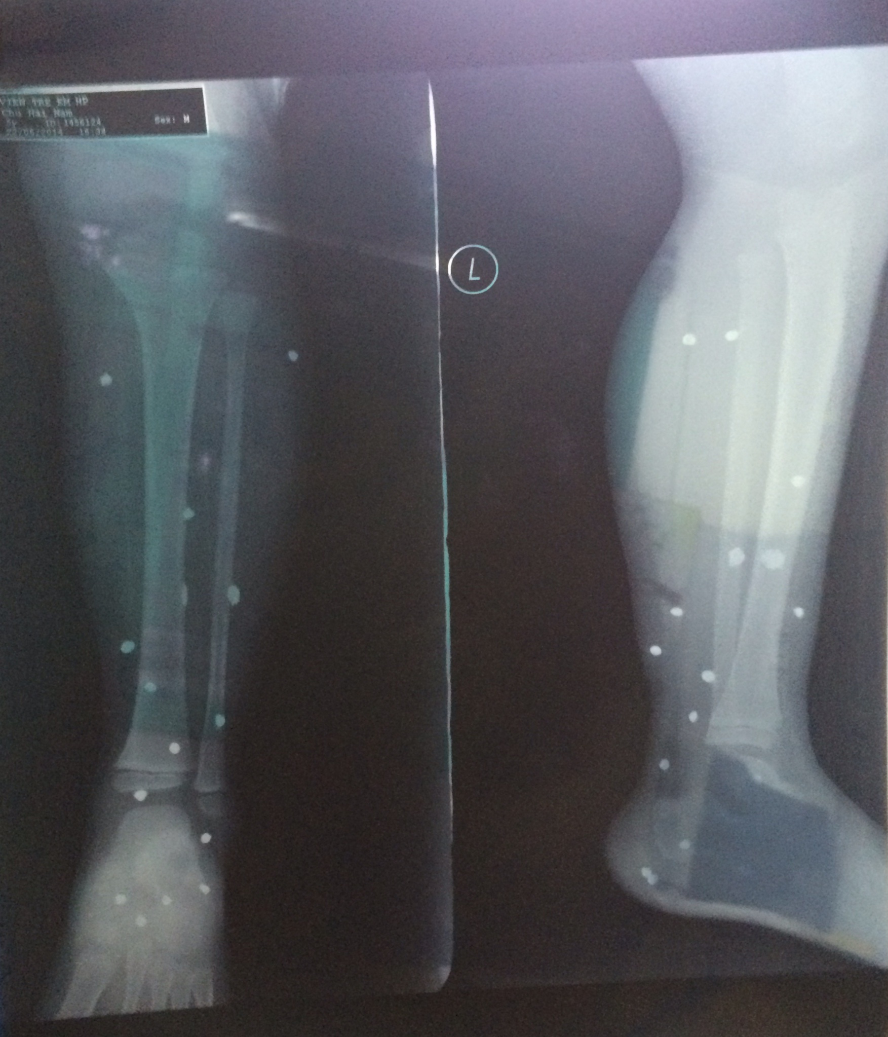 Hình ảnh chụp X-quang các thương tích của bé Nam