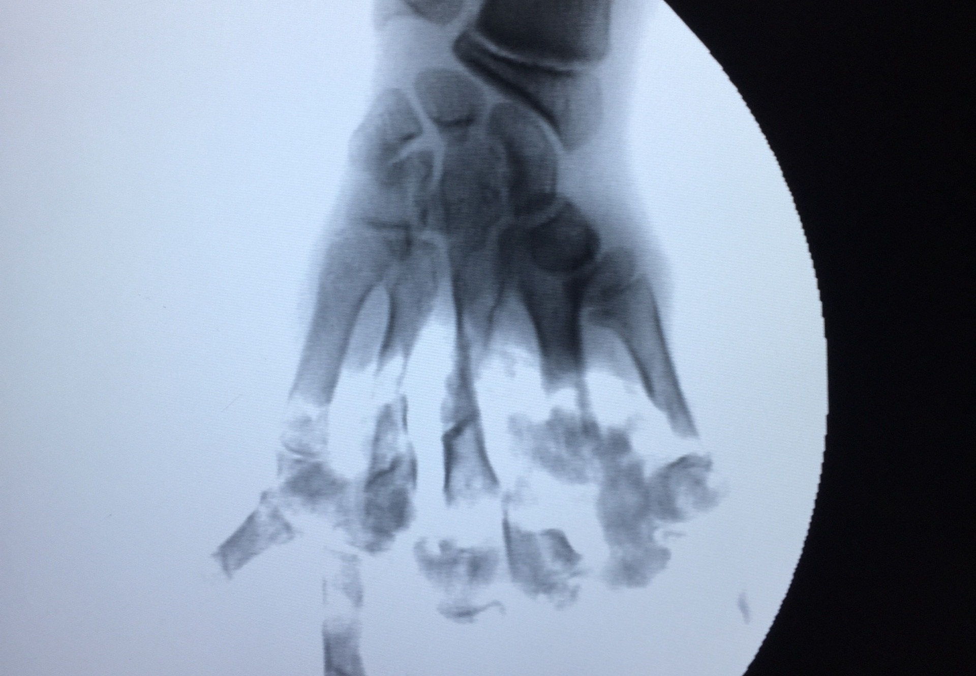 Bé 13 tuổi bị nát bàn tay ảnh 2 Be 13 tuoi bi nat ban tay anh 2