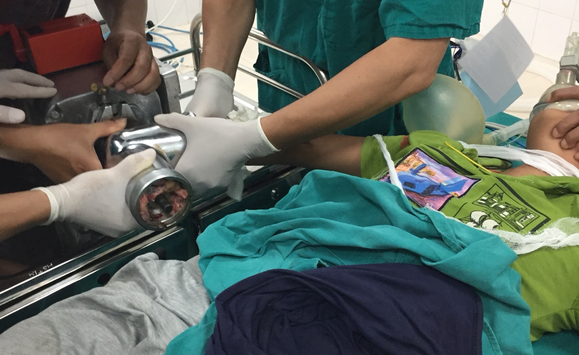 Be trai 13 tuoi bi may xay thit nghien nat ban tay hinh anh