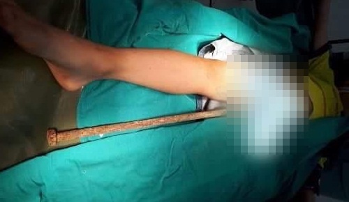 Cuu song be trai 6 tuoi bi thanh sat dam xuyen co the hinh anh