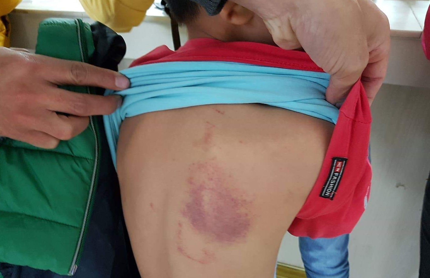 Giáo viên đánh học sinh tím lưng ảnh 1 Giao vien danh hoc sinh tim lung anh 1