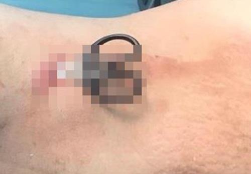 Dam keo vao nguc vi tram cam anh 1