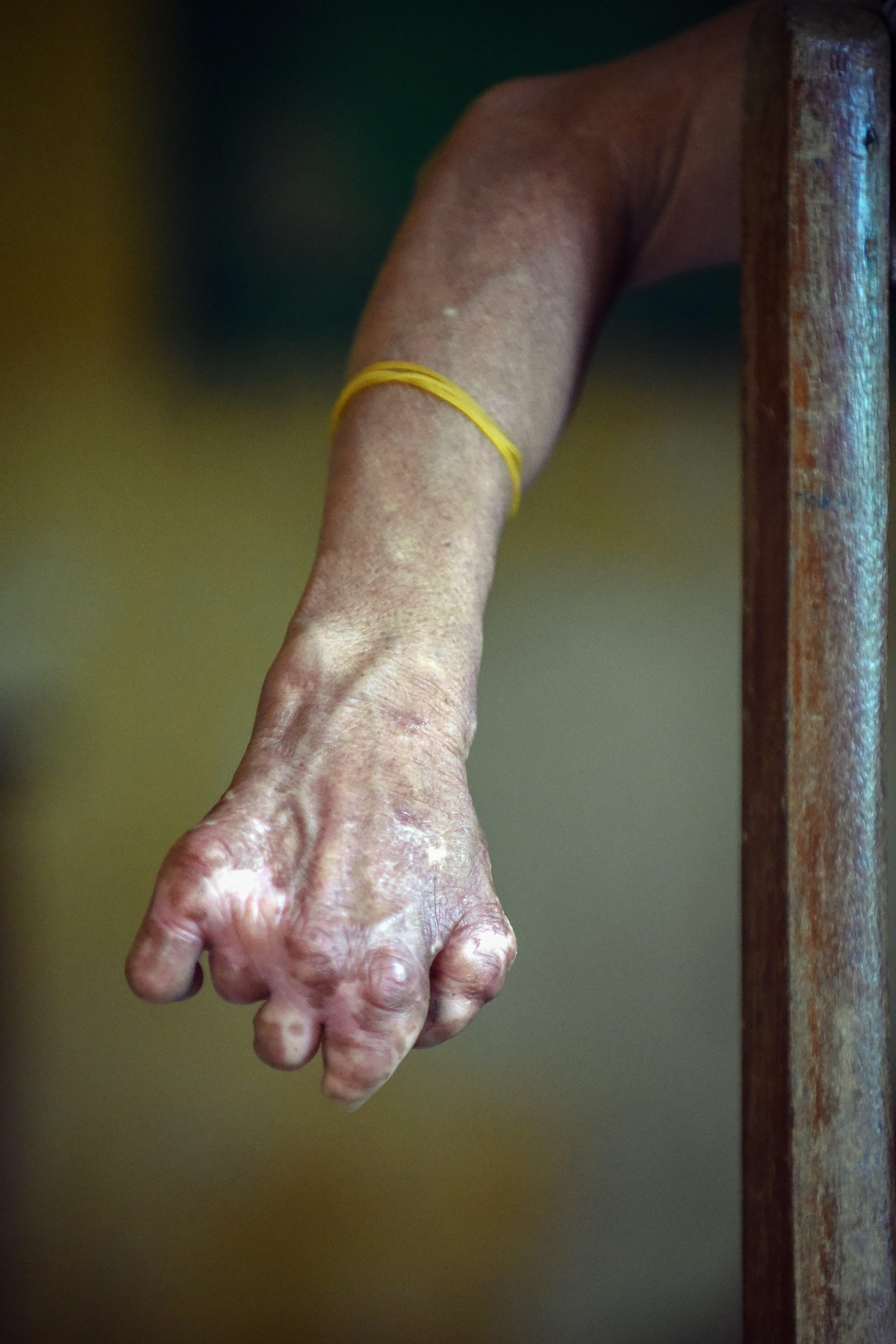 benh phong cui anh 17