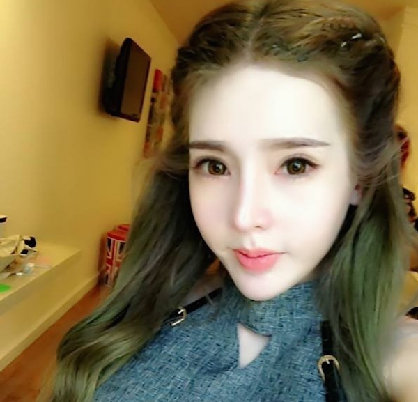 Nhìn vào những bức ảnh sau khi V. trở nên xinh đẹp lạ thường, người xem có thể thấy cô gái này đã trải qua hàng loạt phẫu thuật từ tiểu phẫu cho tới đại phẫu như nâng mũi, chỉnh gò má, gọt hàm, độn cằm, chỉnh răng, bơm môi, bơm ngực và hút mỡ toàn thân. Thậm chí, mới đây nhất, V. còn đăng tải ảnh mình phẫu thuật kéo chân tại bệnh viện. 