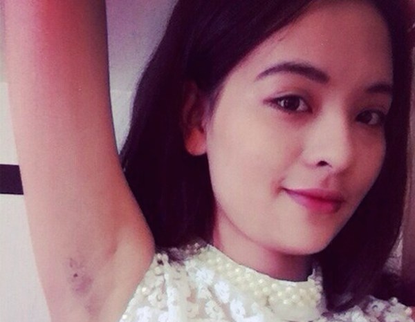 Trao luu khoe vung da duoi canh tay cua gioi tre hinh anh