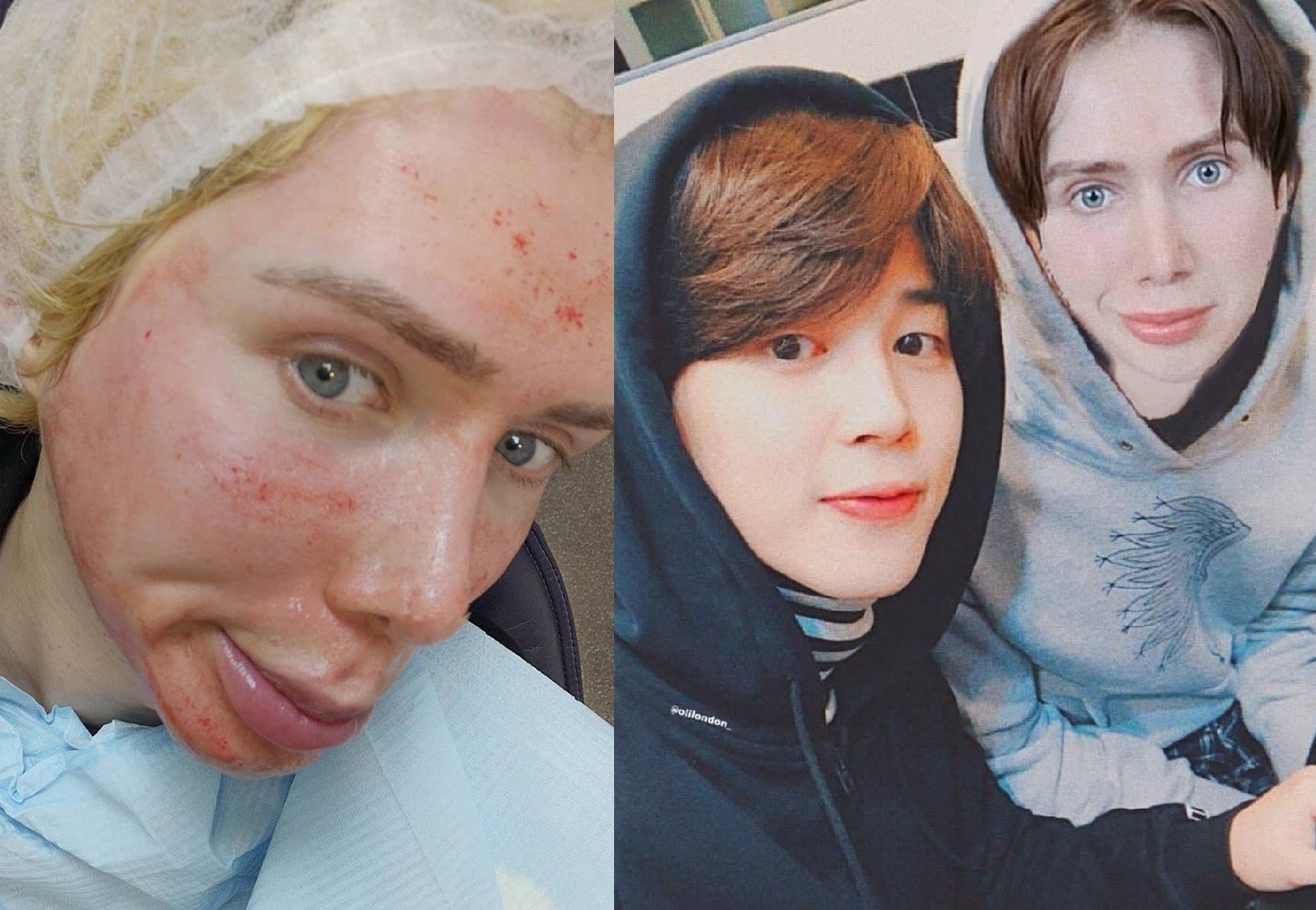 Sau nhieu lan dao keo, chang trai lai tiem trang de giong Jimin hon hinh anh