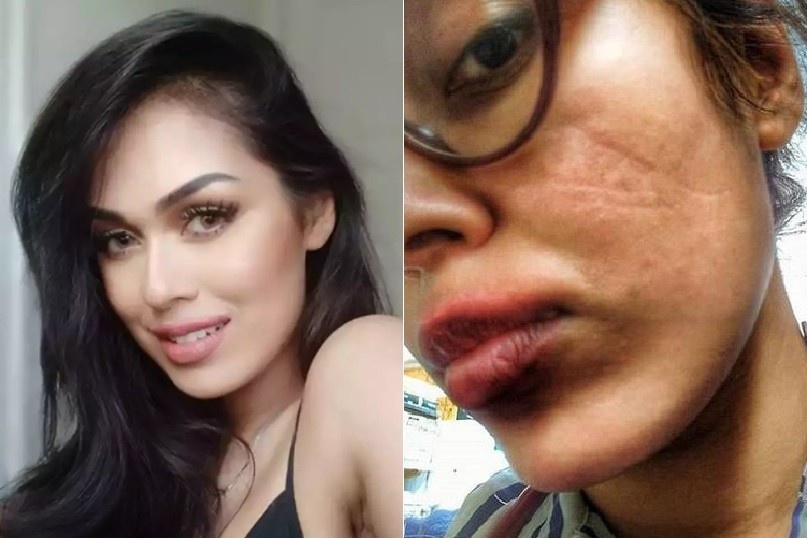 Mat hoa hau Anh bi ton thuong vi deo khau trang hinh anh