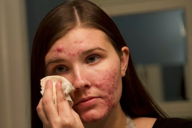 Co gai song chung voi mun truyen cam hung cho nhieu nguoi hinh anh