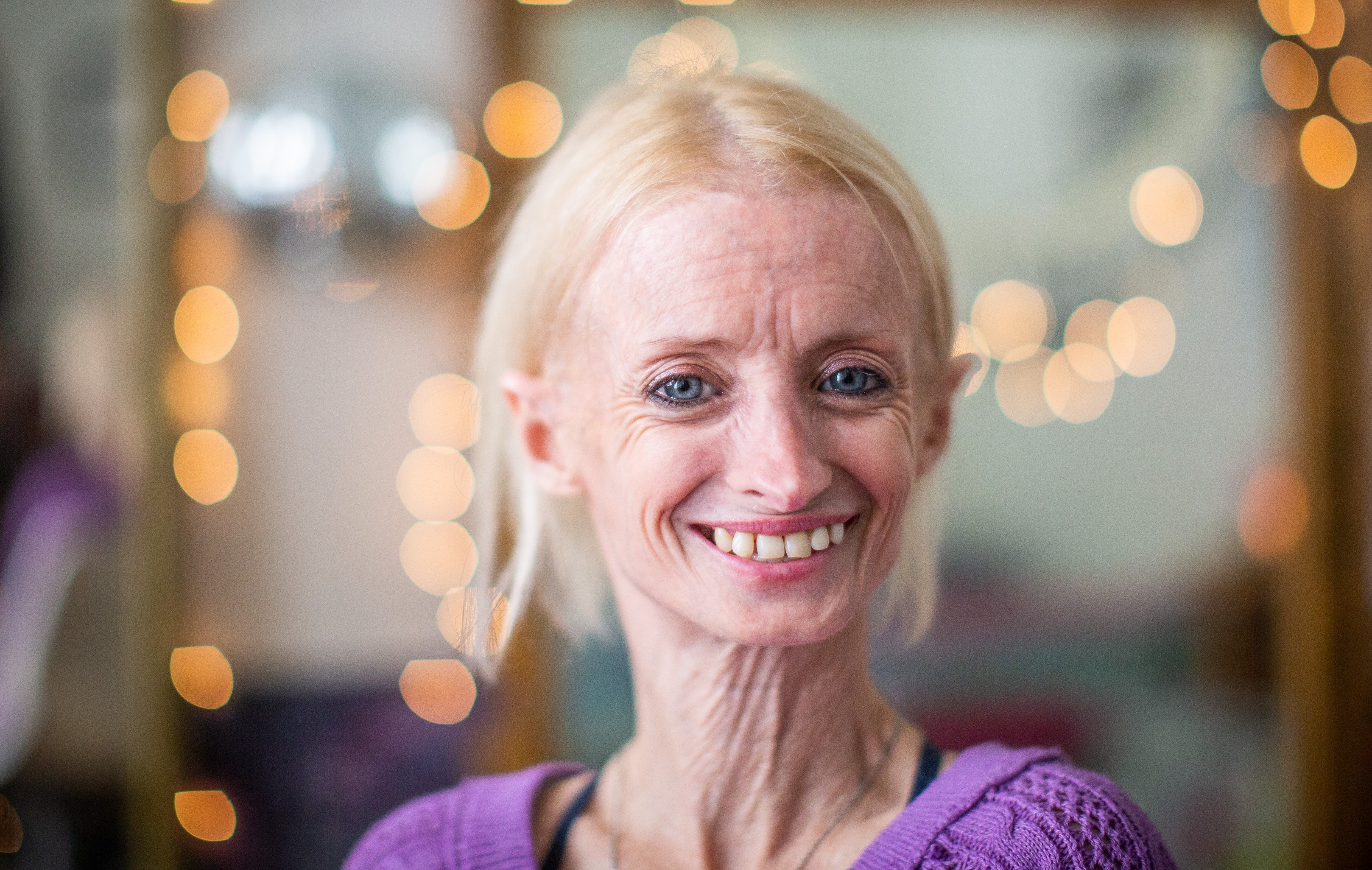 Nguoi phu nu bi lao hoa som, chi nang 26 kg hinh anh