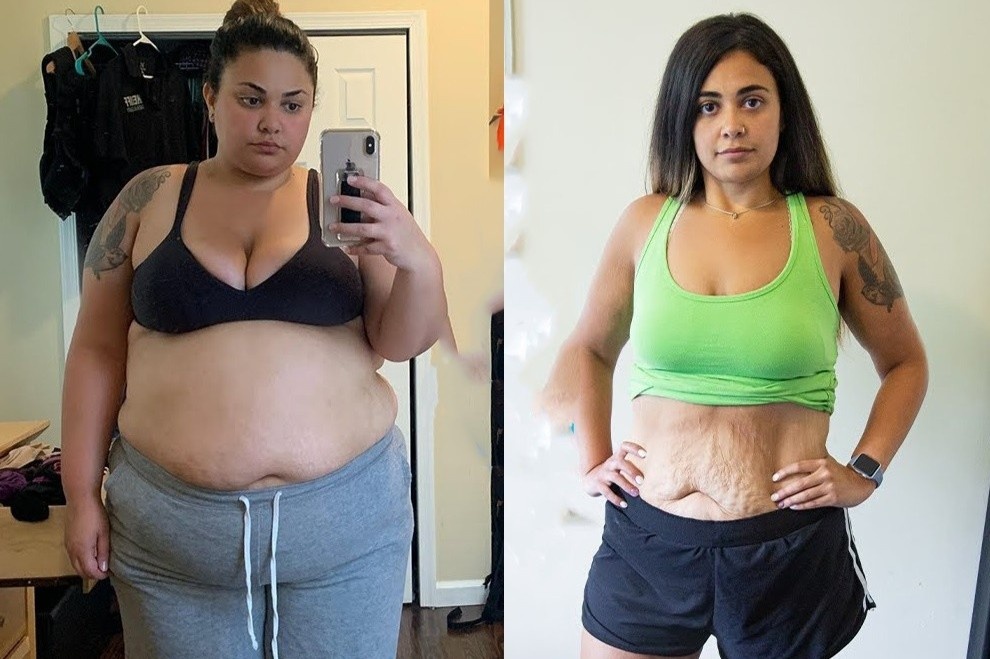 Co gai co nhieu da thua sau khi giam gan 60 kg hinh anh