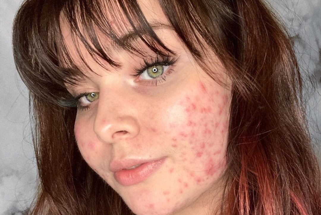 Co gai khong che mun tren guong mat hinh anh