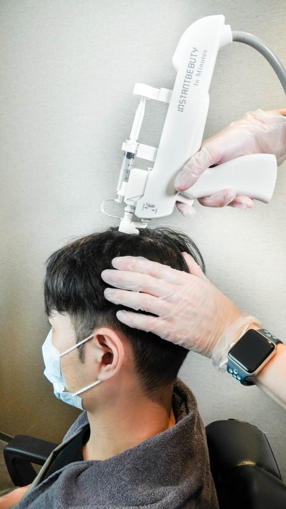 hói đầu ảnh 4 hoi dau anh 4