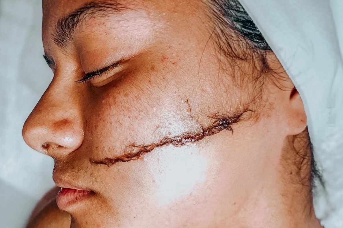 Trao luu cao long mat hinh anh