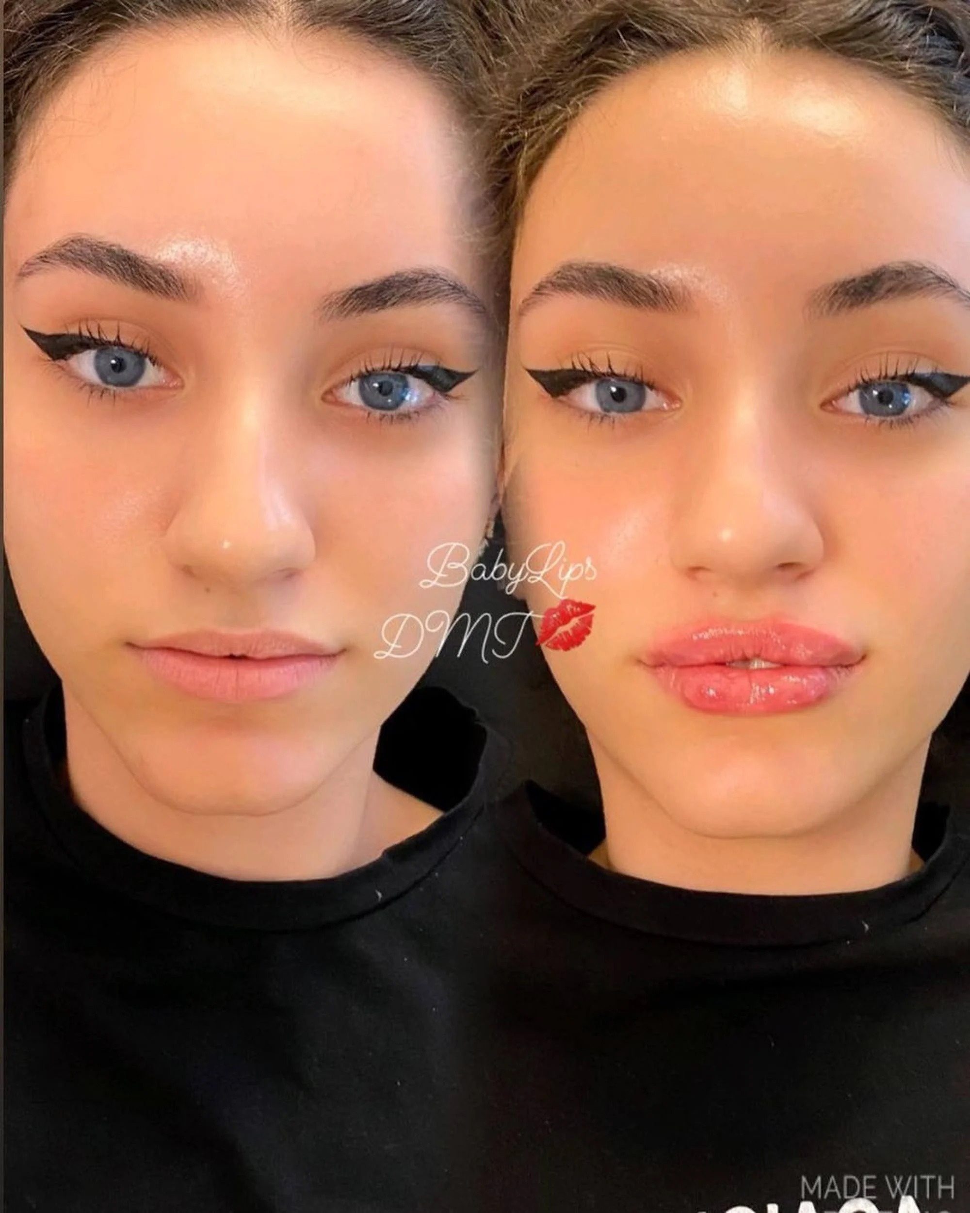 tiêm môi tại nhà ảnh 2 tiem moi tai nha anh 2