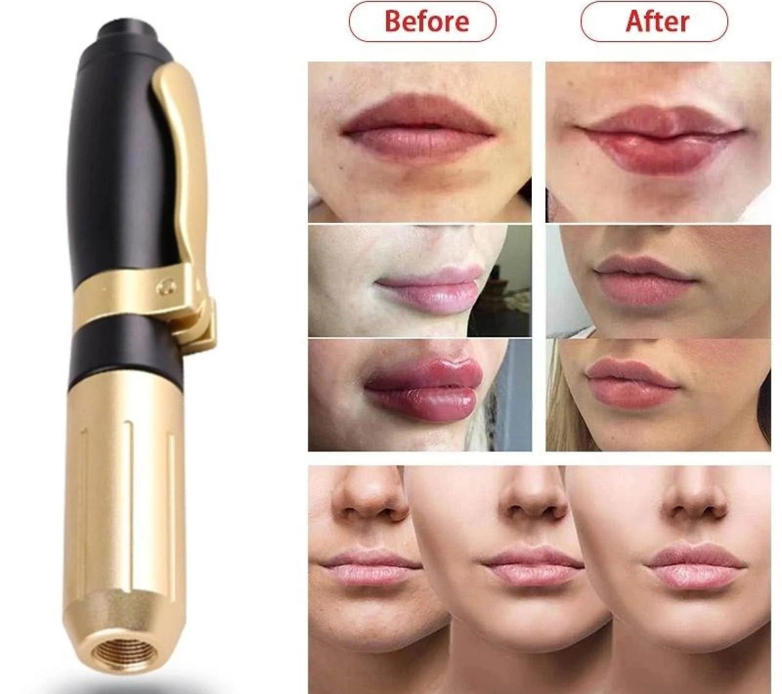 tiêm môi tại nhà ảnh 3 tiem moi tai nha anh 3