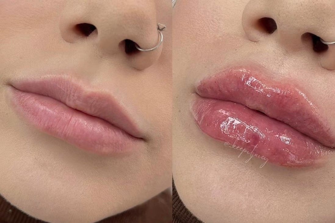 tiêm môi tại nhà ảnh 1 tiem moi tai nha anh 1