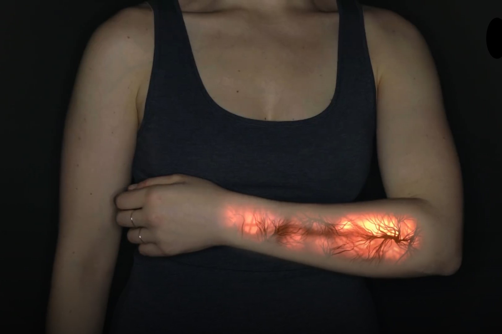 Co gai mac benh hiem, cam nhan duoc noi dau the xac cua nguoi khac hinh anh