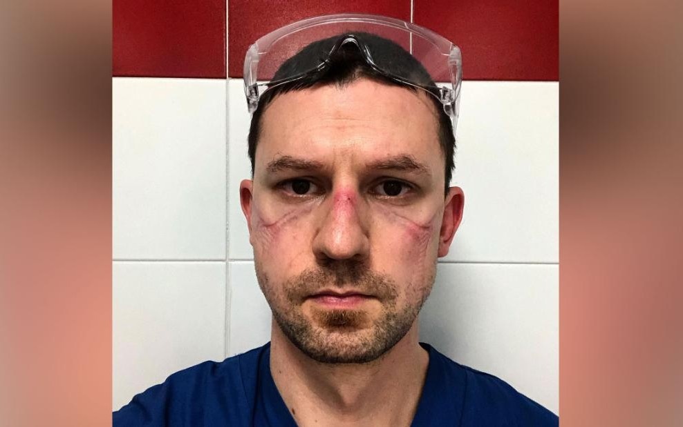 Hinh anh vet han tren mat bac si 'sieu nhan' lan truyen tren mang hinh anh